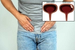 Bladder Cancer reasons, Bladder Cancer, why is bladder cancer common in men, Cigarette