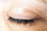 Eyelash Dandruff updates, Eyelash Dandruff health, all about eyelash dandruff, Dry skin