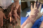 how to get rid of black henna scars, henna tattoo side effects, henna tattoo cause aussie woman to almost lose her hand, Hair dye