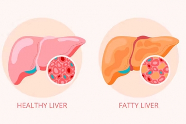 How to Reverse Grade 2 Fatty Liver?