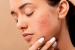 pimples, skin care products, 10 ways to get rid of pimples at home, All skin types